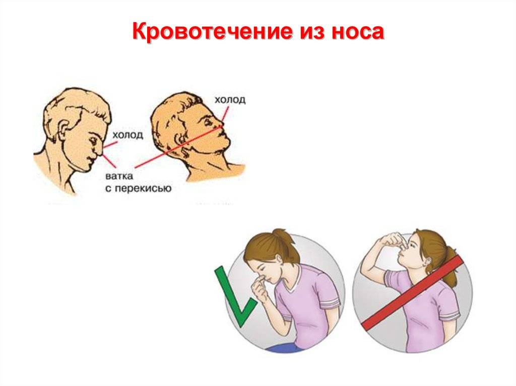 Как остановить кровь из носа: правила оказания первой помощи