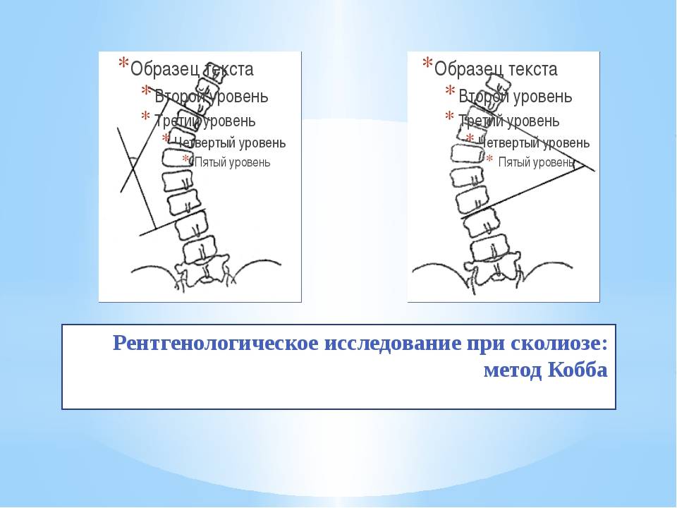 Угол кобба