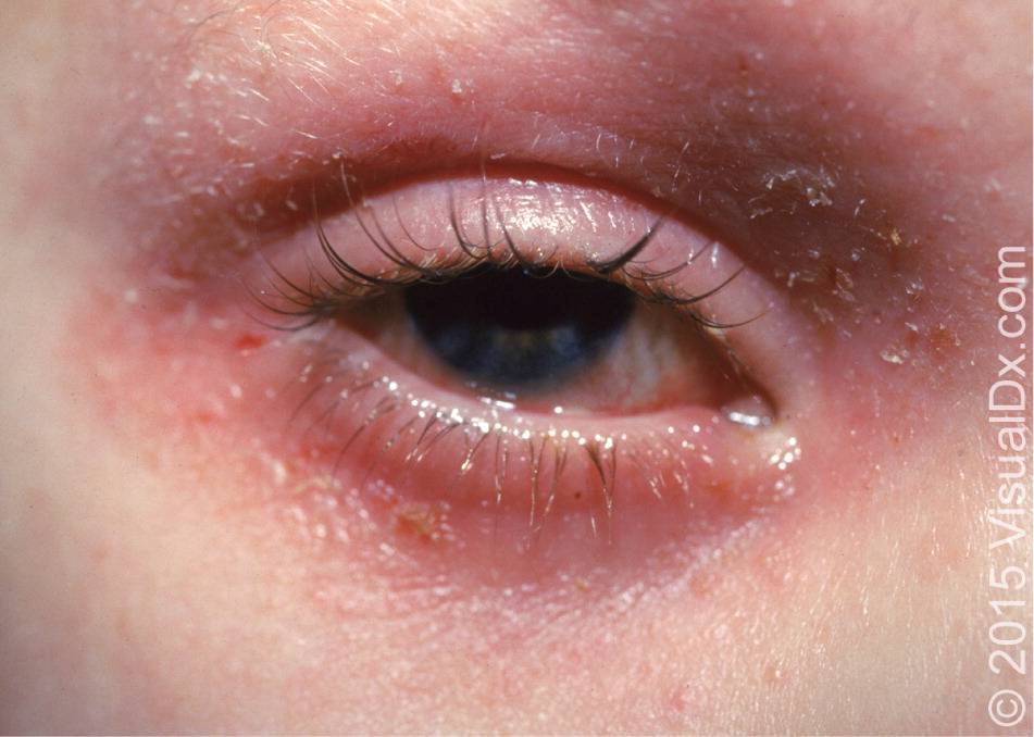 Аллергия под глазами — причины и лечение у детей и взрослых