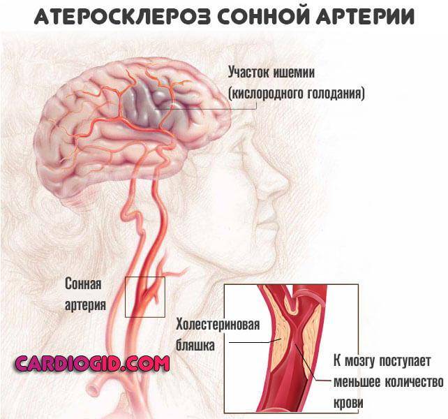 Атеросклероз сосудов головного мозга: симптомы и лечение