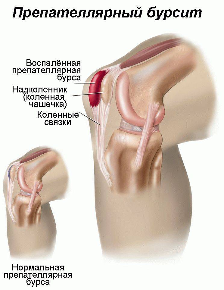 Супрапателлярный бурсит коленного сустава - симптомы и лечение | zaslonovgrad.ru