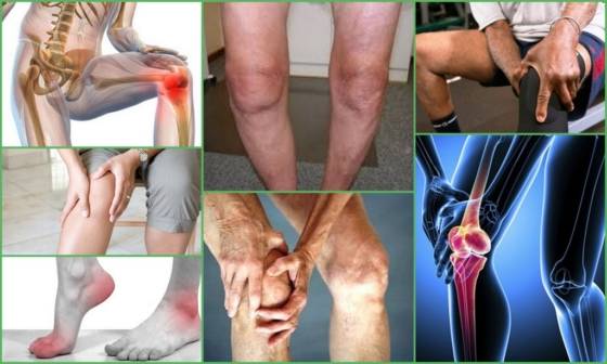 Гонартроз 2 степени коленного сустава - лечение, упражнения и физиопроцедуры