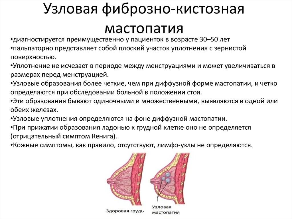 Лечение фиброзной мастопатии народными средствами - 30 рецептов!