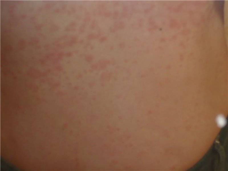 Почему появляются красные круглые пятна на коже обзор заболеваний и методов лечения | moninomama.ru