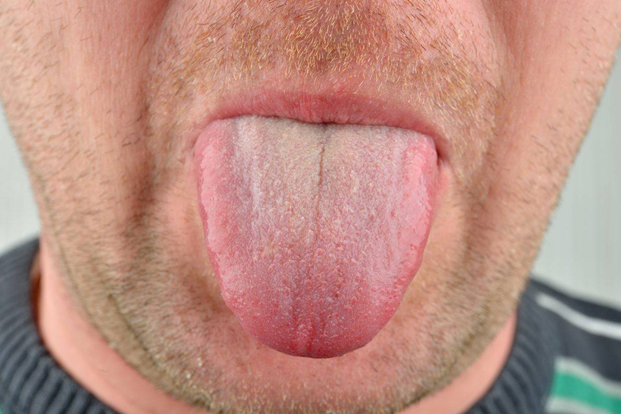 Изучили язык: covid способен вызывать поражения полости рта
