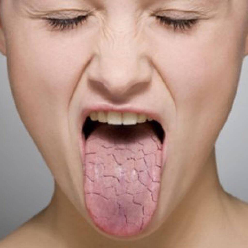 Сухость во рту при гастрите - причины данного симптомы | spacream.ru