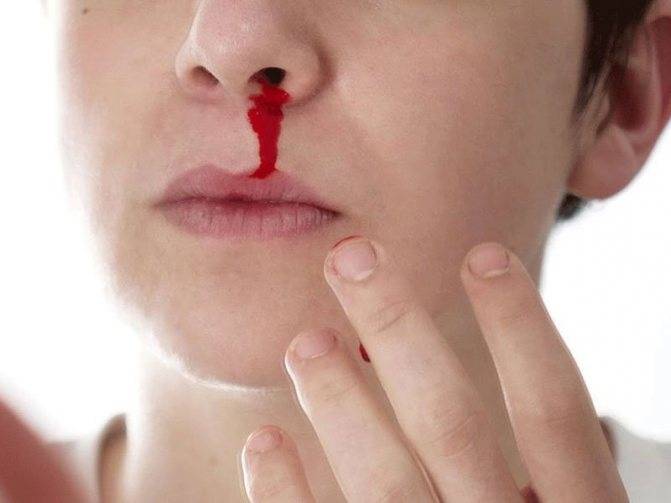 Почему идет кровь из носа у ребенка и как остановить кровотечение из носа