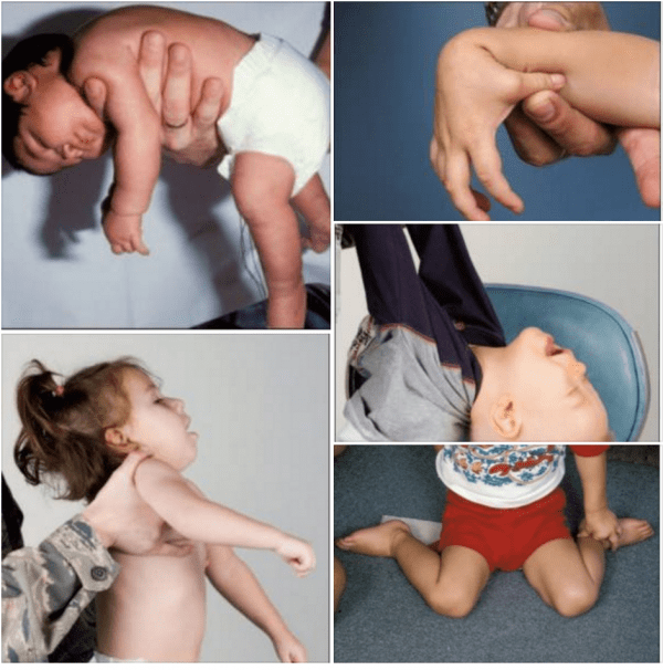 Синдром мышечной дистонии у грудничка и новорожденных детей