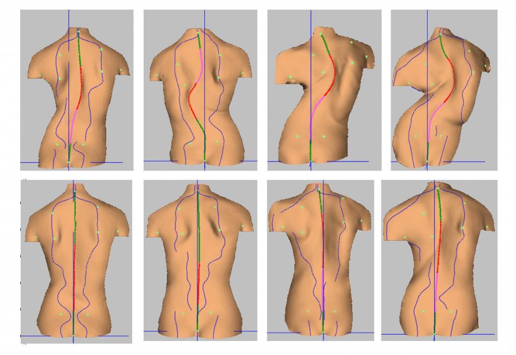 Упражнения для правостороннего сколиоза грудного отдела позвоночника