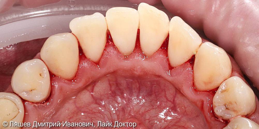 Кровоточат десны при чистке зубов – причины и что делать