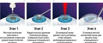 Лазерная коррекция зрения методом фрк: отзывы, описание, суть метода