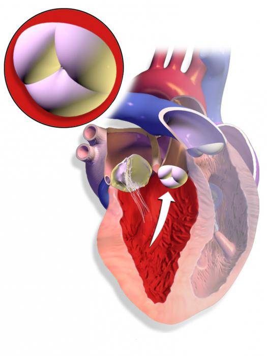 Аортальная регургитация клапана (1 степени): что это такое, причины — заболевания сердца