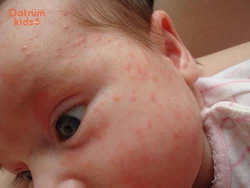 Проявления коронавируса: какие высыпания на коже должны насторожить