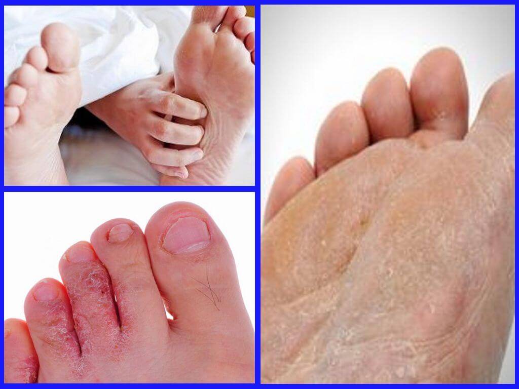 Слезает кожа между пальцами ног – причины, фото, лечение