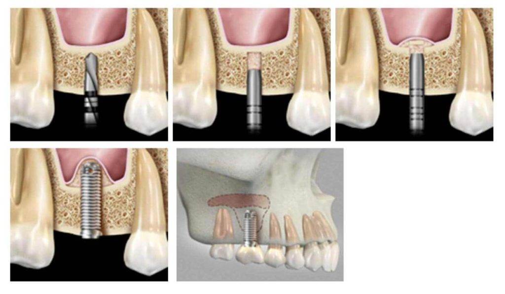 Синуслифтинг в стоматологии, что это такое, какая стоимость операции?