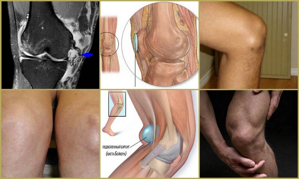 Супрапателлярный бурсит коленного сустава – симптомы и лечение