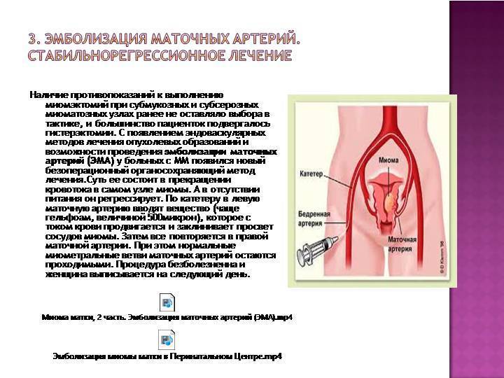 Эмболизация маточных артерий при миоме матки: лечение и последствия