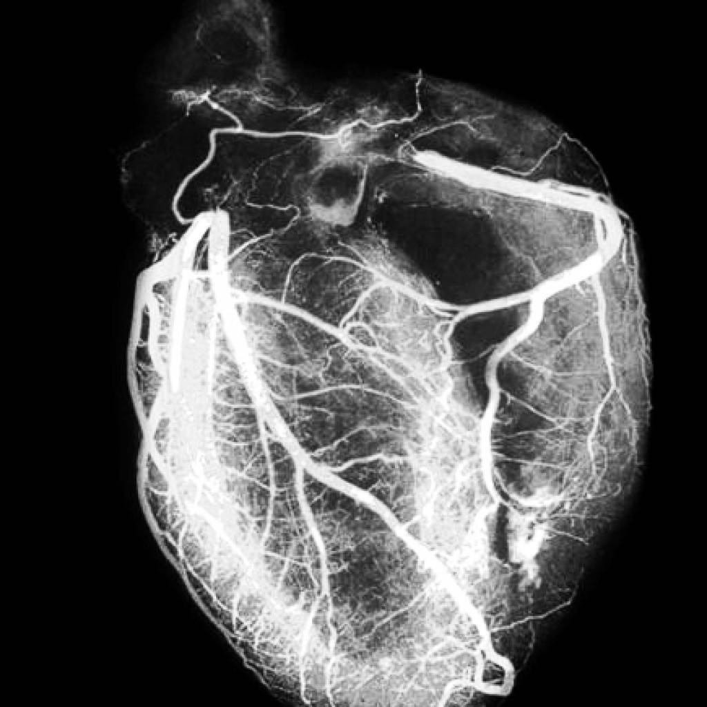 Все о компьютерной томографии сердца