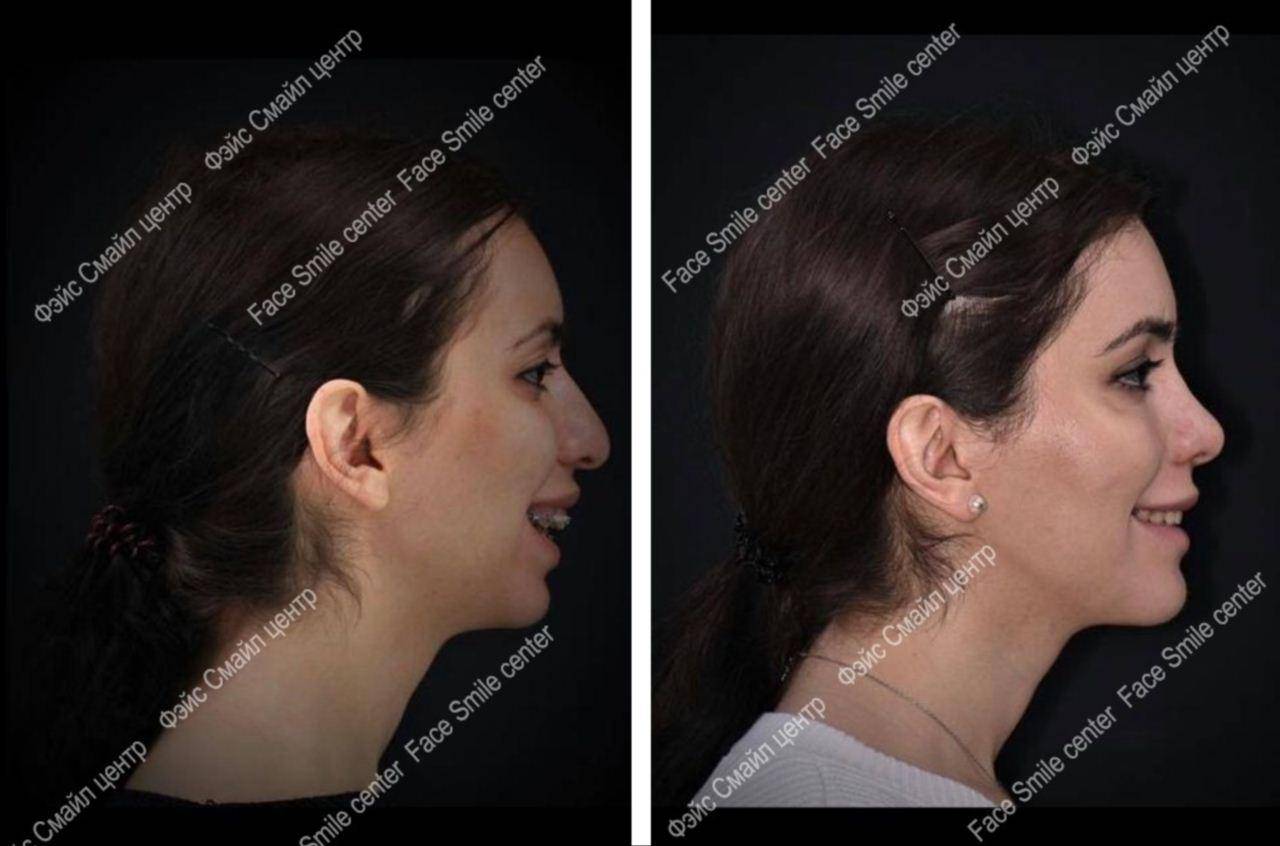Прикус после выравнивания брекетами фото до и после: исправление положения клыков, верхних и нижних зубов