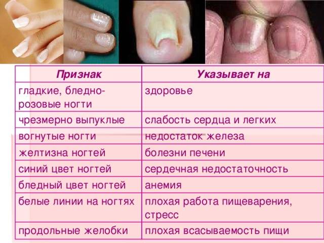 Причины появления белых пятен на ногтях и способы их лечения