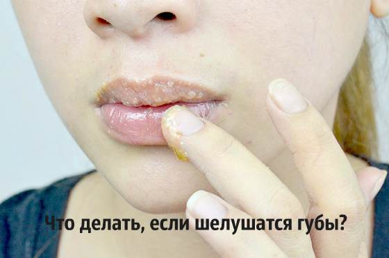 Причины почему сохнут и трескаются губы у мужчин и женщин, что делать?