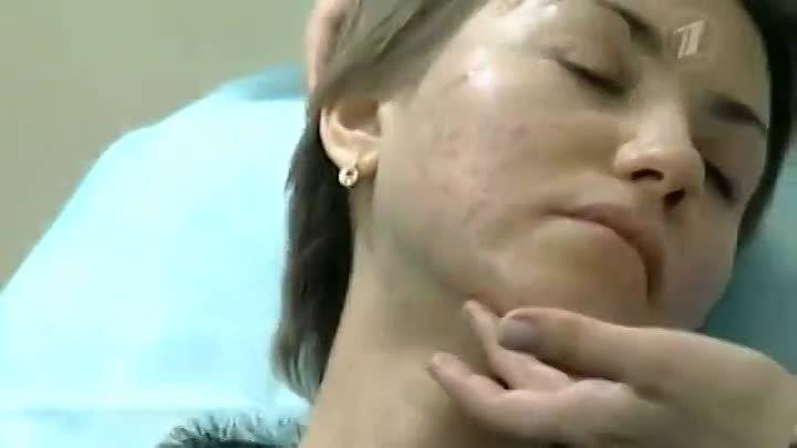 Прыщи после 50 лет у женщин — что это, на лице, причины, лечение, что делать, щитовидка