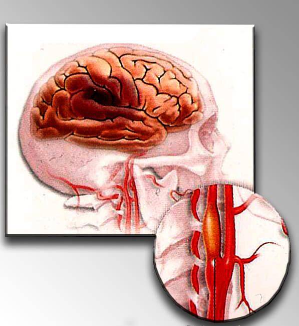Атеросклероз сосудов головного мозга - что это такое, причины, стадии, патогенез и последствия