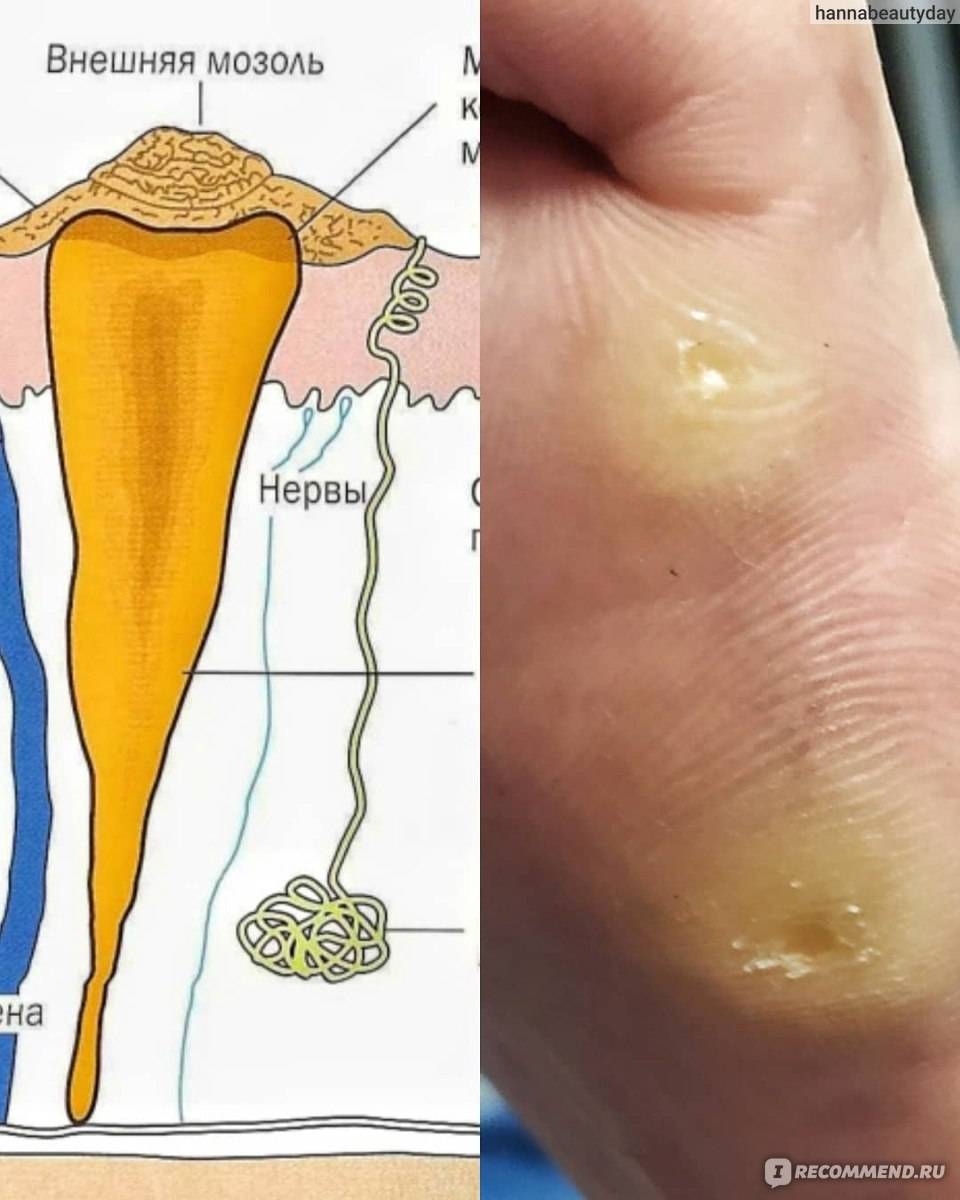 Сухие мозоли на пальцах ног: лечение, как вывести в домашних условиях | компетентно о здоровье на ilive