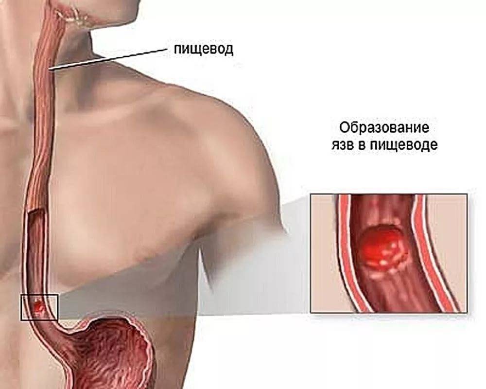 Dieta esofagitis hernia de hiato