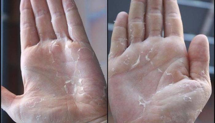 Причины и лечение шелушения кожи на руках и ногах