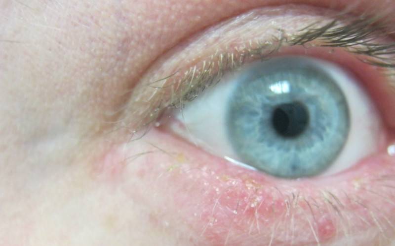 Глазной клещ (демодекоз) - лечение в домашних условиях