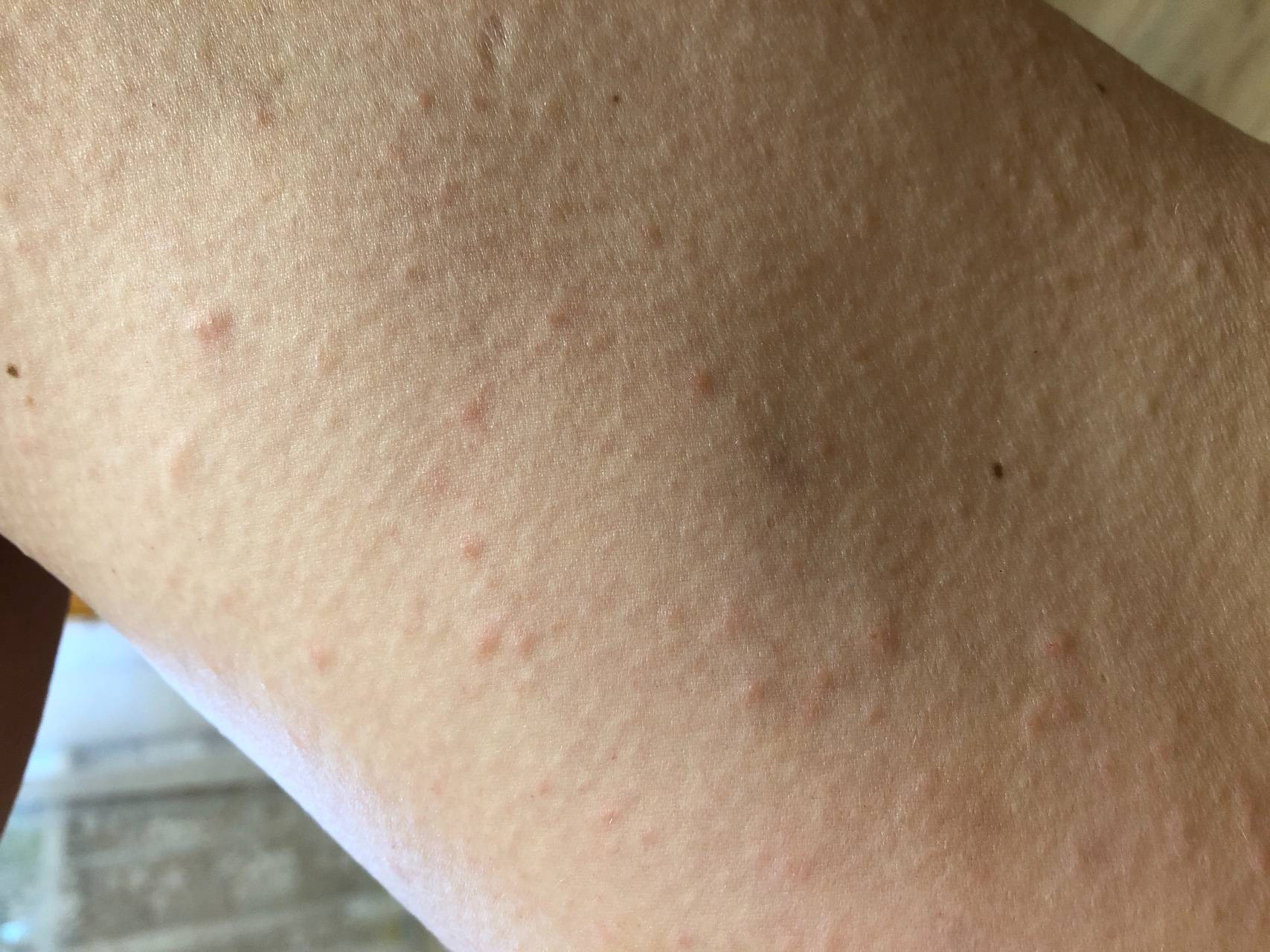 Сыпь на животе: как выглядит аллергия на животе, причины, лечение, фото