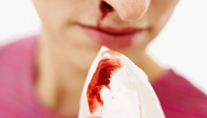 Почему кровь из носа пошла ночью во время сна - что делать, чем лечить