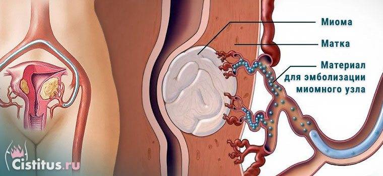 Лапароскопия и эмболизация маточных артерий при миоме