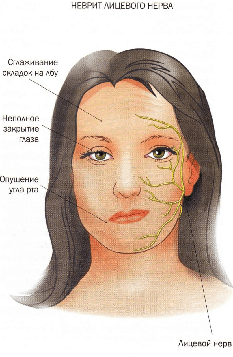 Воспаление тройничного нерва на лице: симптомы, лечение