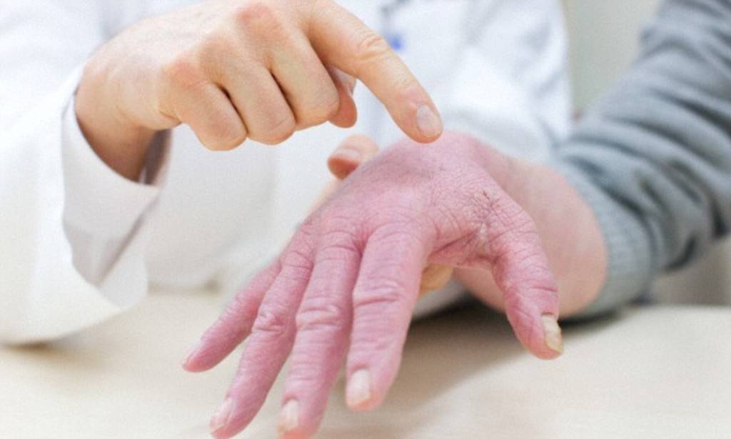 Аллергический дерматит на руках лечение | лечим аллергию