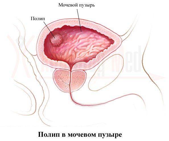 Лейкоплакия мочевого пузыря у мужчин и женщин: лечение, симптомы, диета, секс, анализы мочи и признаки лейкоплакии стенок мочевого пузыря