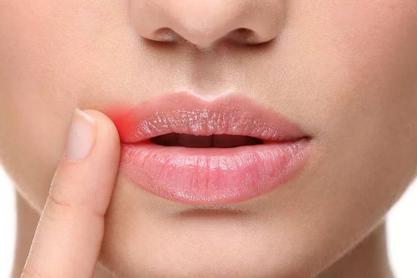 Почему заеды в уголках губ неожиданно образуются, болят и трескаются?