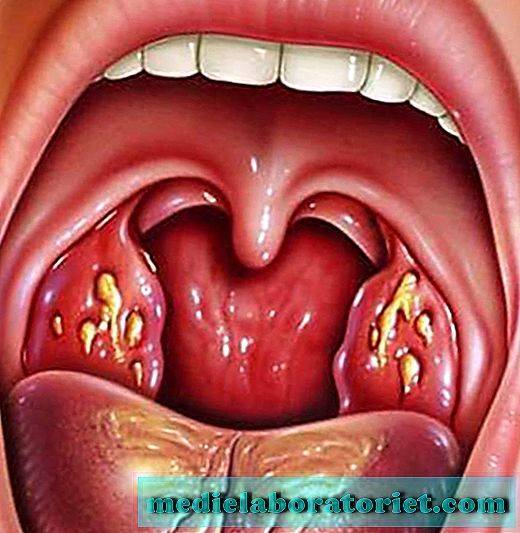 Симптомы и лечение инфекций в горле