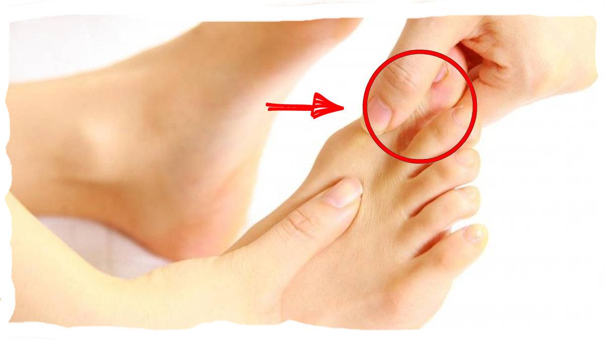 На ноге под большим пальцем болит косточка | советы доктора
