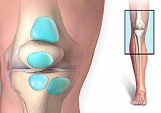 Супрапателлярный бурсит коленного сустава: симптомы, лечение...