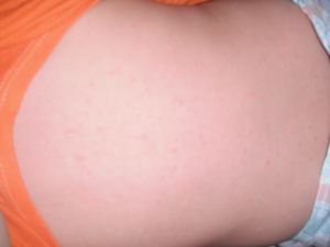 Виды аллергической сыпи (пятен) на коже - как выглядит, чем лечить (+фото)