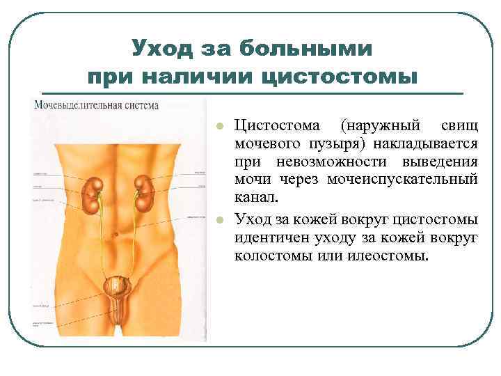 Цистостома (цистома) мочевого пузыря у мужчин - уход и осложнения | moninomama.ru
