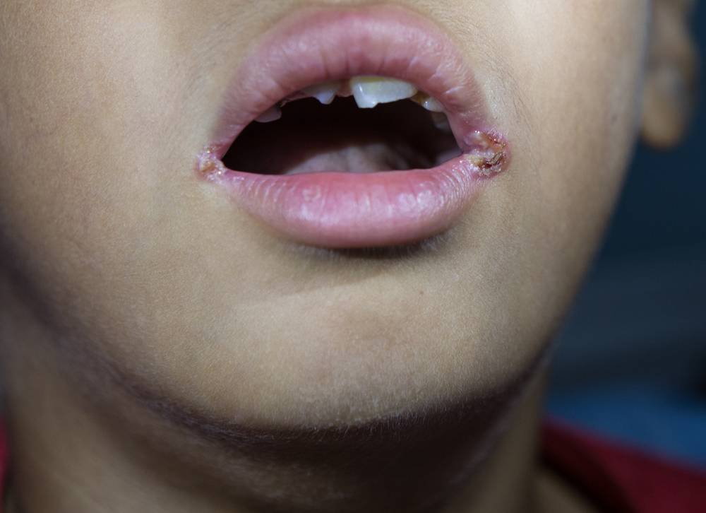 Чем лечить заеды в уголках рта: топ 5 мазей для лечения в домашних условиях