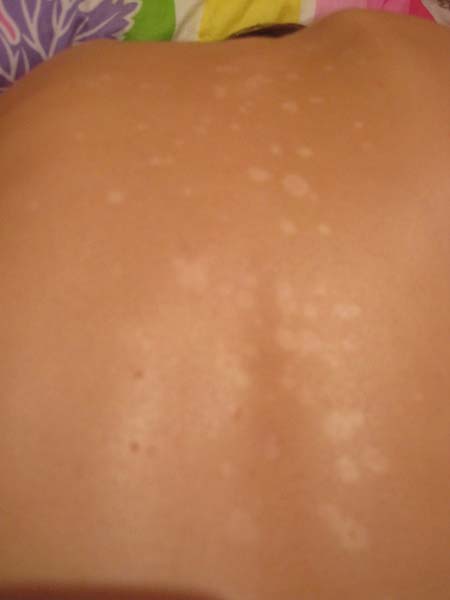Белые пятна на коже - как называется болезнь, причины и лечение