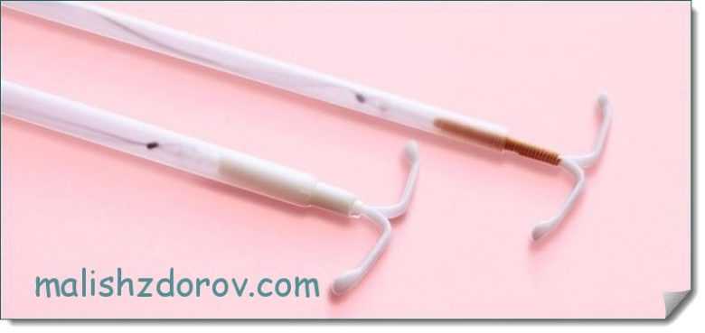 Внутриматочная противозачаточная спираль: что это такое, как работает, отзывы о контрацептиве, виды, показания и противопоказания, фото