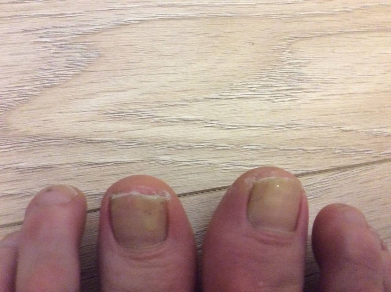 Коричневые пятна на ногтях ног: причины появления, что это и как лечить