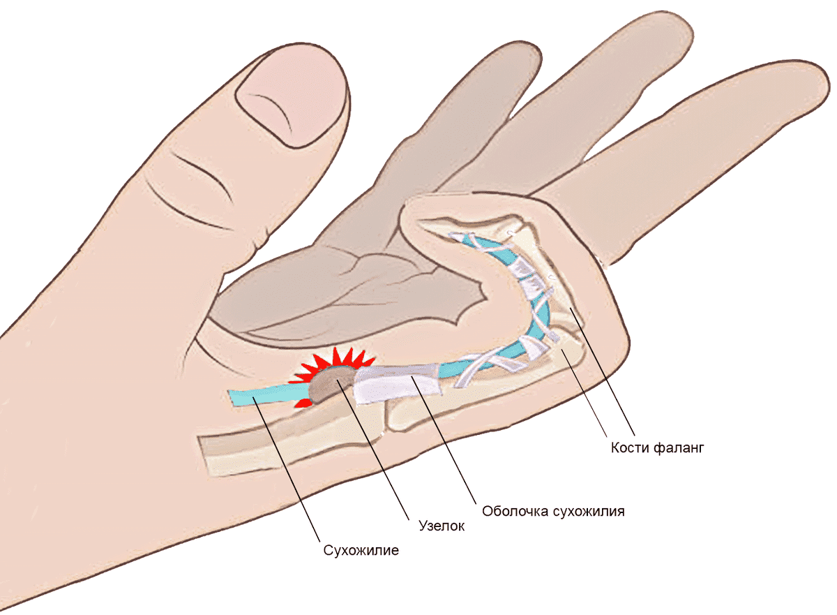 Простата пальчиком. Лигаментит щелкающий палец. Стенозирующий лигаментит. Болезнь Нотта мкб. Стенозирующий лигаментит де Кервена. Стенозирующий лигаментит пальца кисти мкб.