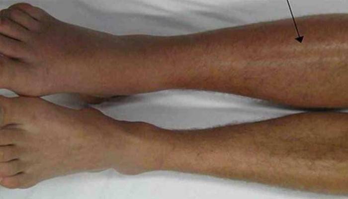 Тянет правую ногу от бедра: причины, что делать при тянущих болях