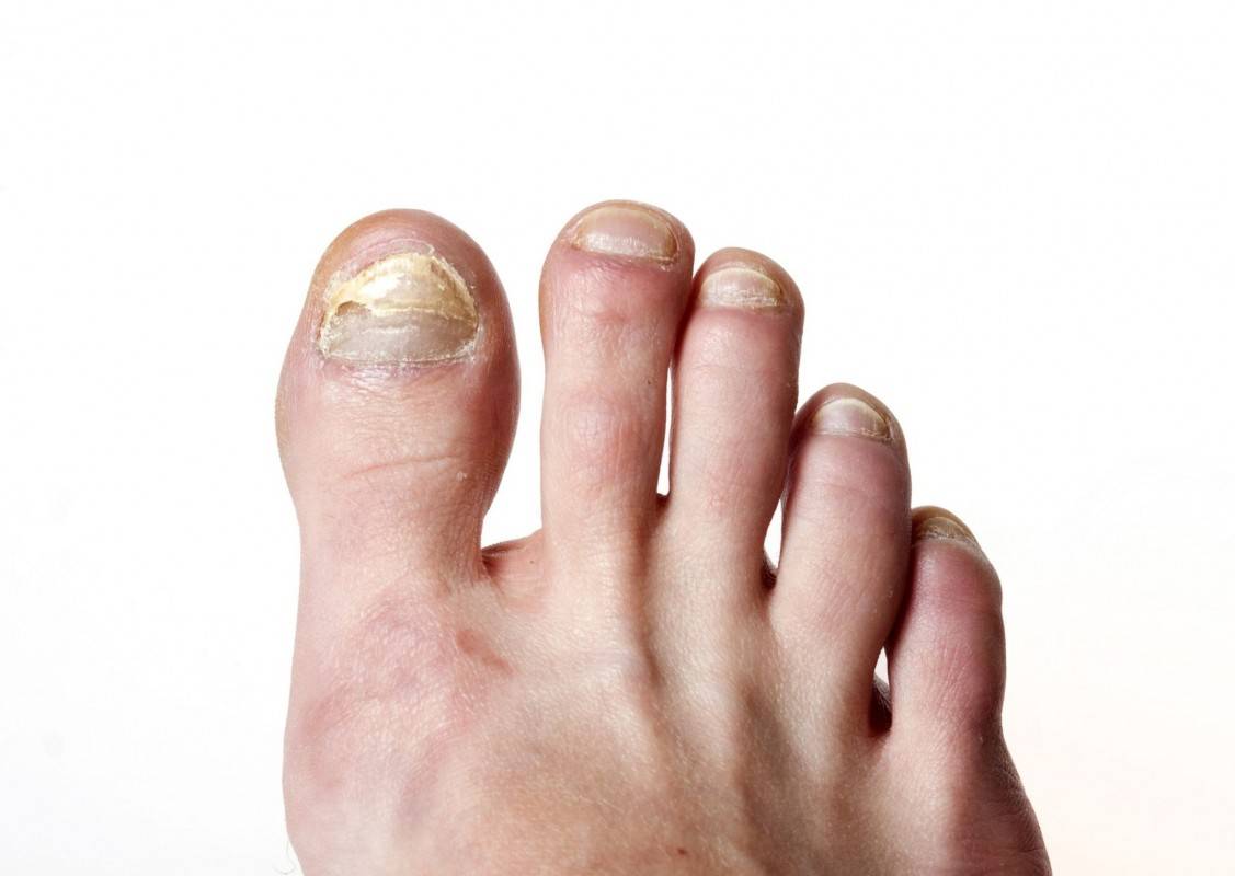 Потемнели ногти на больших пальцах ног: фото, причины, лечение
